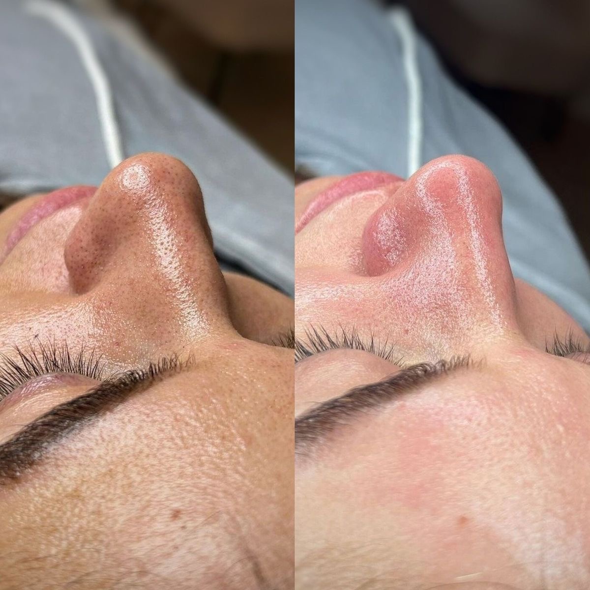 Limpeza de Pele 3